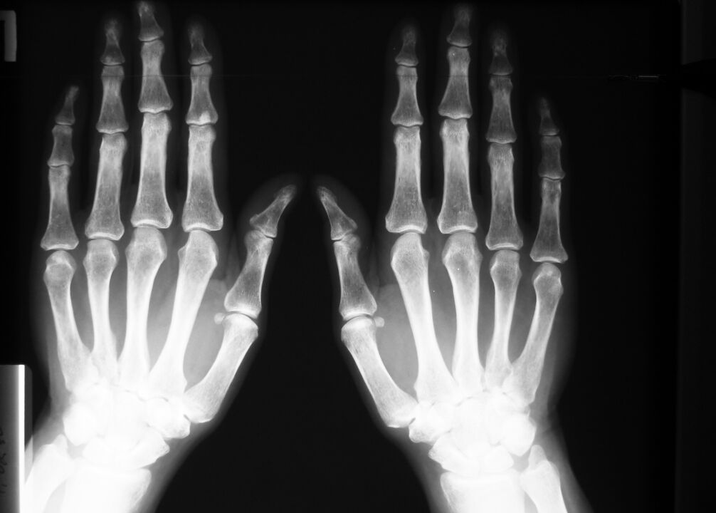 rentgen k diagnostice bolesti v kloubech prstů