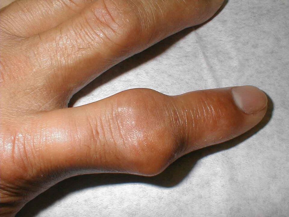 tofy v kloubu prstu jako příčina bolesti